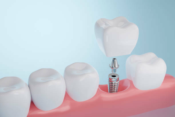 Pasos para colocar implantes dentales