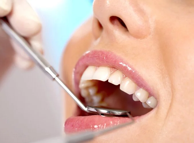 carillas dentales avilés dental clinic