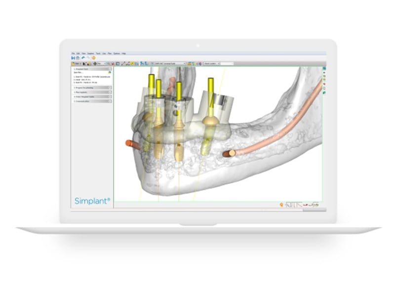 Software dental avanzado SIMPLANT mostrando diseño de implante guiado por computadora para procedimientos de precisión en Avilés Digital Dental Clinic.