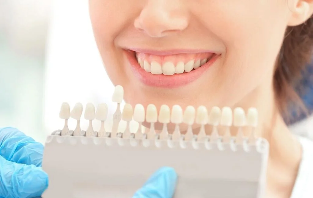 Blanqueamiento dental en Málaga